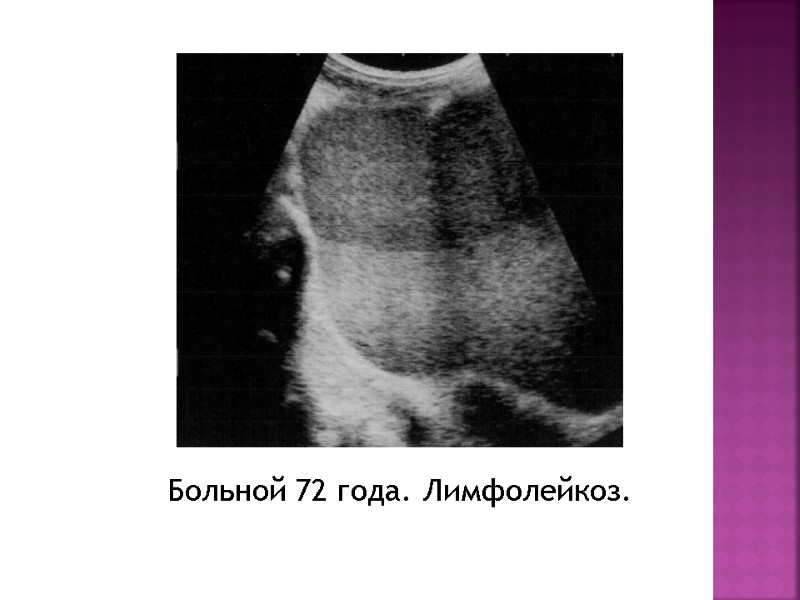 Больной 72 года. Лимфолейкоз.